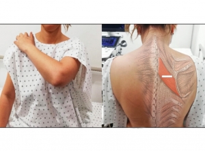 Nuevo tratamiento para el dolor cervical